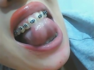 mouth fetish braces